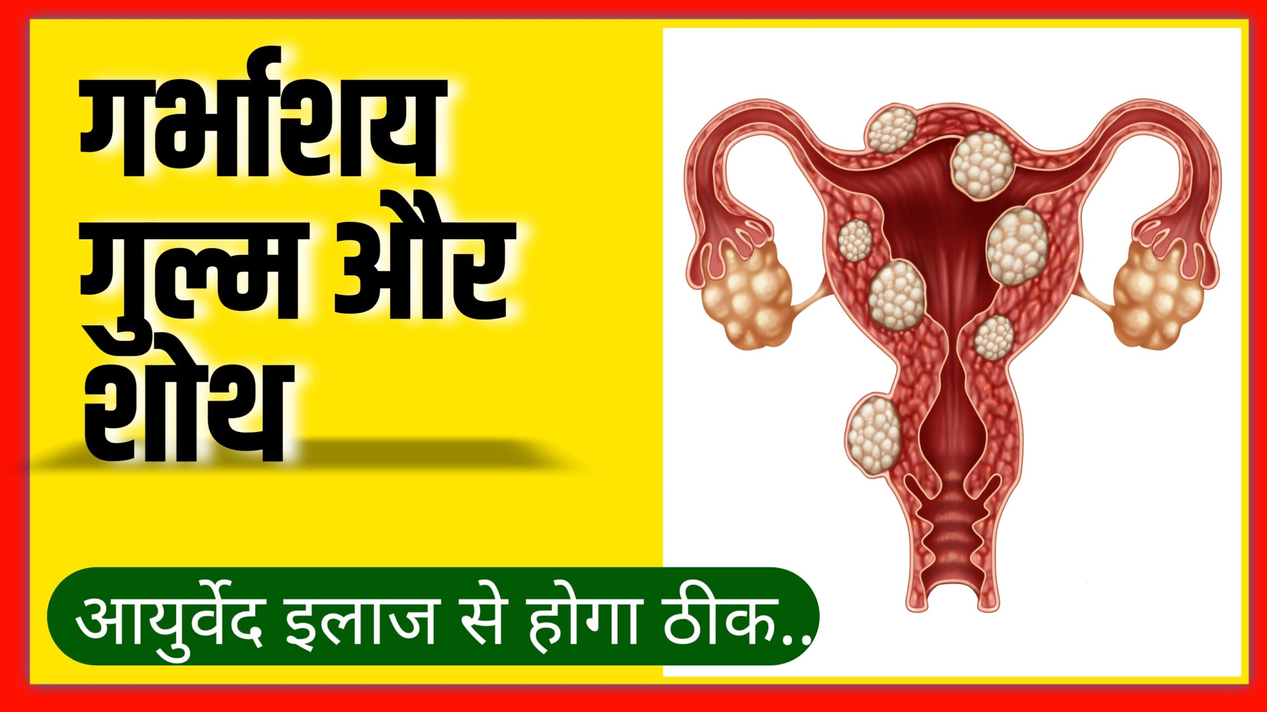गर्भाशय गुल्म (fibroids/tumors)